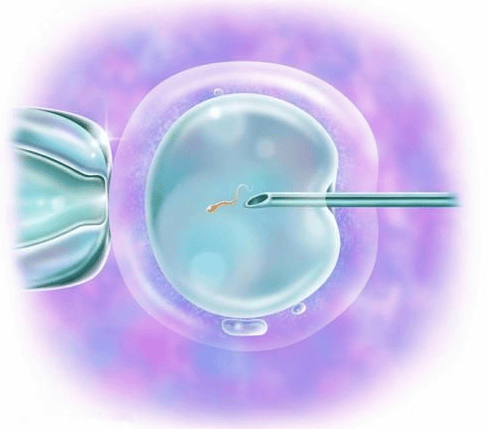 体外受精 IVF-ET